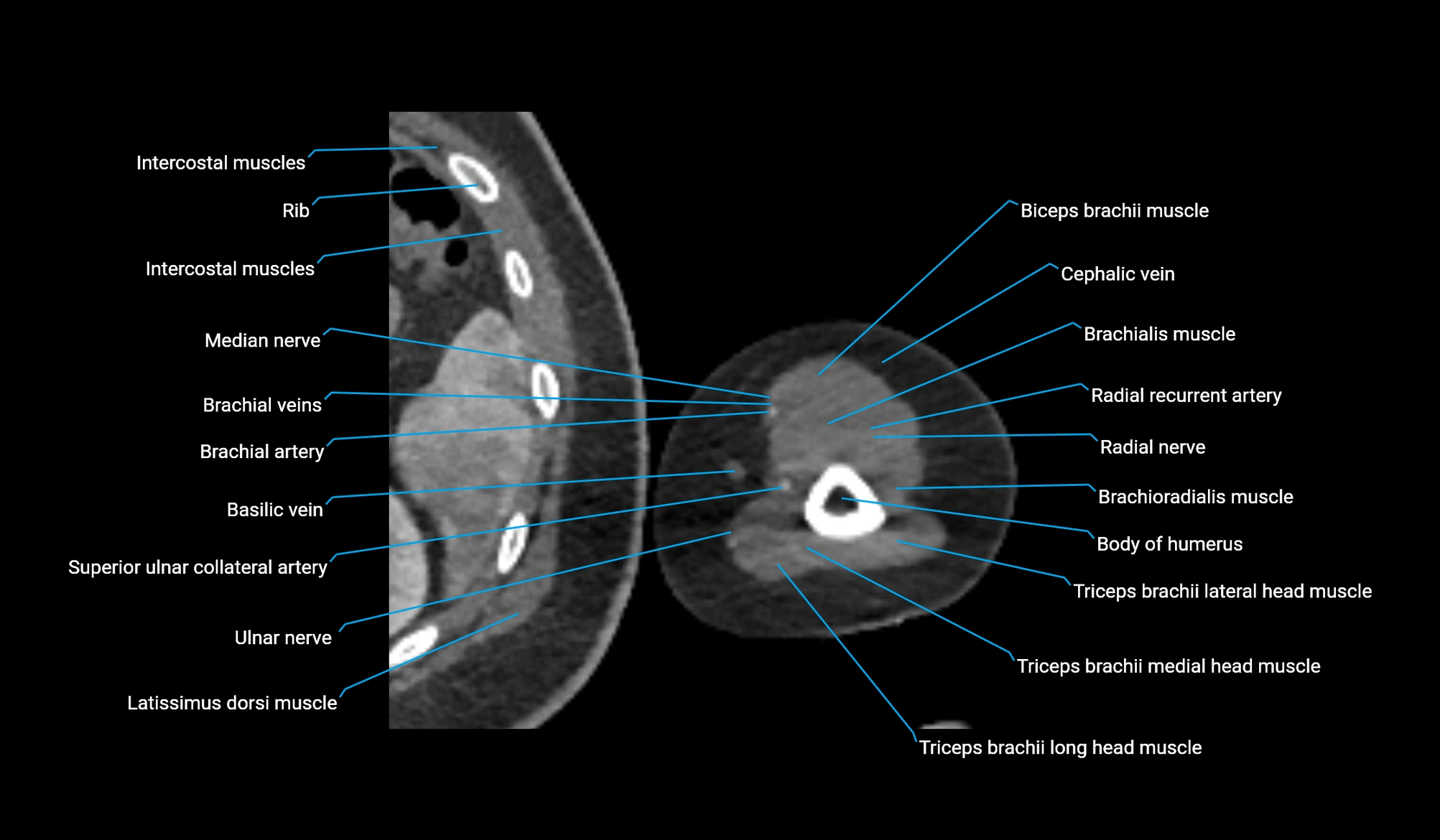 CT upper arm axial  cross sectional anatomy labelled radiology image -00326.webp